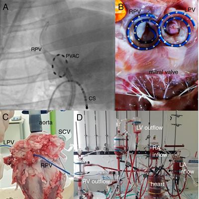 Localized Pulmonary Vein Scar Promotes Atrial Fibrillation in High Left Atrial Pressure